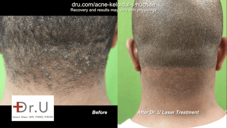 The East Los Angeles patient shows off his new, AKN-free back hairline. No longer self-conscious of the bumps on head scalp, he is able to wear his hair as short as he likes without fear of exposing the hard simple-like bumps previously on his nape. The East Los Angeles patient shows off his new, AKN-free back hairline. No longer self-conscious of the bumps on head scalp, he is able to wear his hair as short as he likes without fear of exposing the hard simple-like bumps previously on his nape.*