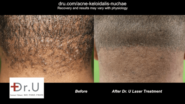 After five laser treatments with Dr. U, this East Los Angeles patient happily reported his bumps were gone.