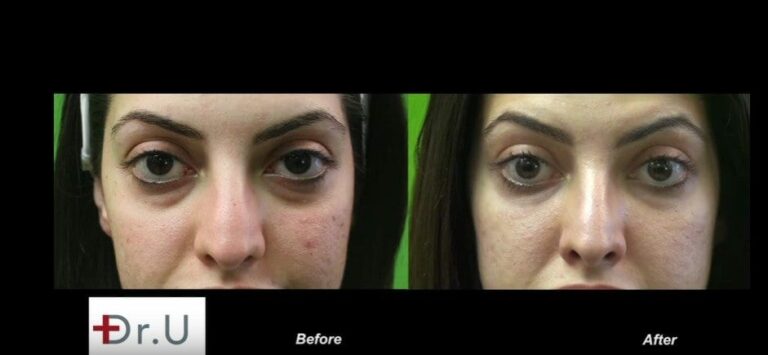 The best dermal filler injection for under the eyes will produce a natural looking outcome without incurring the Tyndall effect 