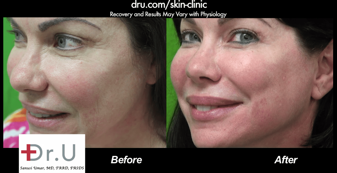 The Belotero dermal filler succeeded at eliminating the fine wrinkle shown on the side of the patient's face *