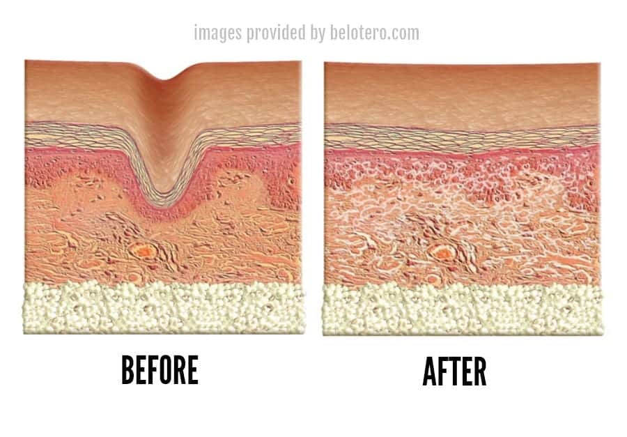 Schematic diagram showing Belotero before and after injection treatment (images provided by belotero.com)