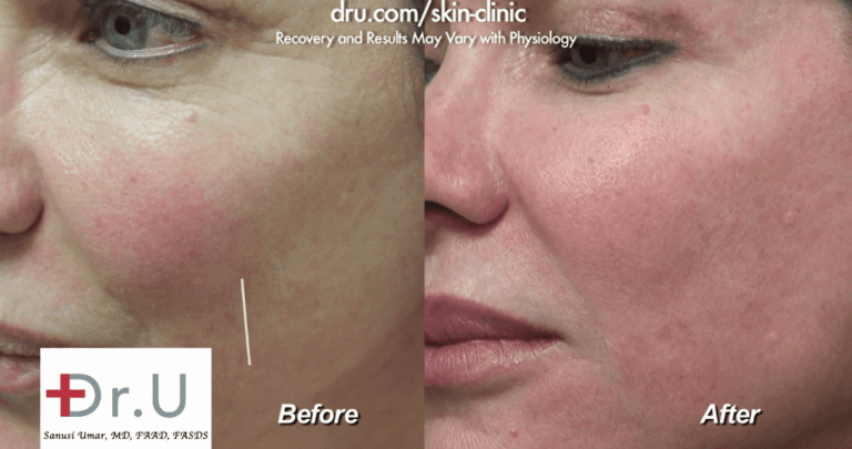 Belotero before and after photos showing close up view of final results 