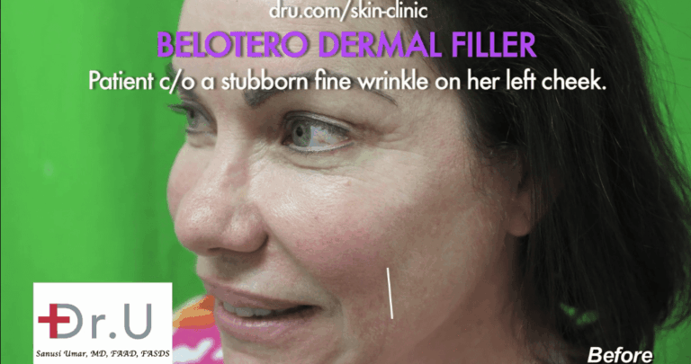 White line shows where the Belotero dermal filler would be applied to eliminate the unwanted wrinkle
