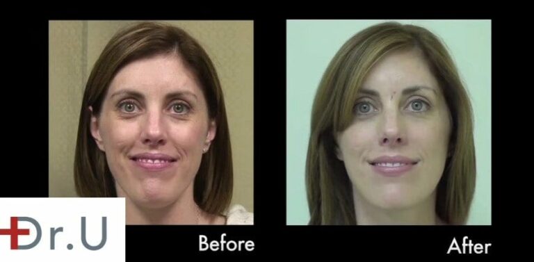 Hyaluronic acid fillers may be the best dermal filler injection for the early onset of laugh lines (nasolabial folds) 