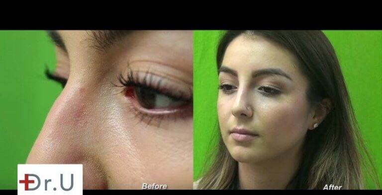Radiesse, which is made of calcium hydroxyapatite, is perhaps the best dermal filler to use for non-surgical nose jobs 