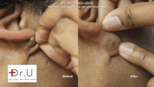 A keloid in an earlobe piercing may be effectively removed through flap excision surgery. Here are before and after photos of this patient's procedure.