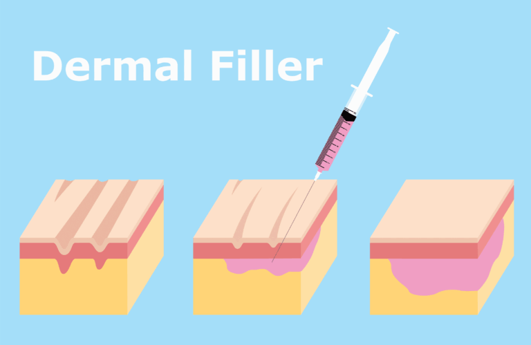 A rudimental illustration that shows how dermal fillers can be used to lift sagging jowls without surgery.