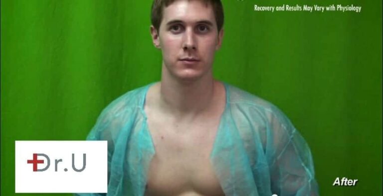Vbeam proved to be the best Rosacea treatment for this Manhattan Beach patient's chest redness