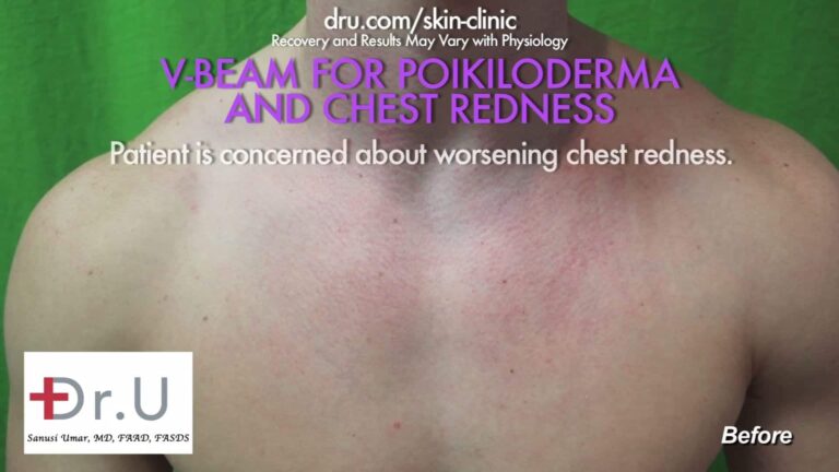 Patient showing redness on his chest before his laser treatment for rosacea