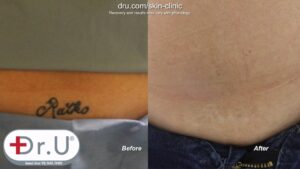 Manhattan Beach patient before and after laser tattoo removal on her lower abdomen.