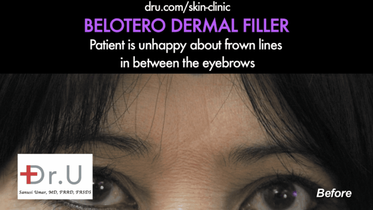 Malibu patient with 11's and superficial line on the side of her face. Dr. U recommended Belotero vs Botox for her treatment.