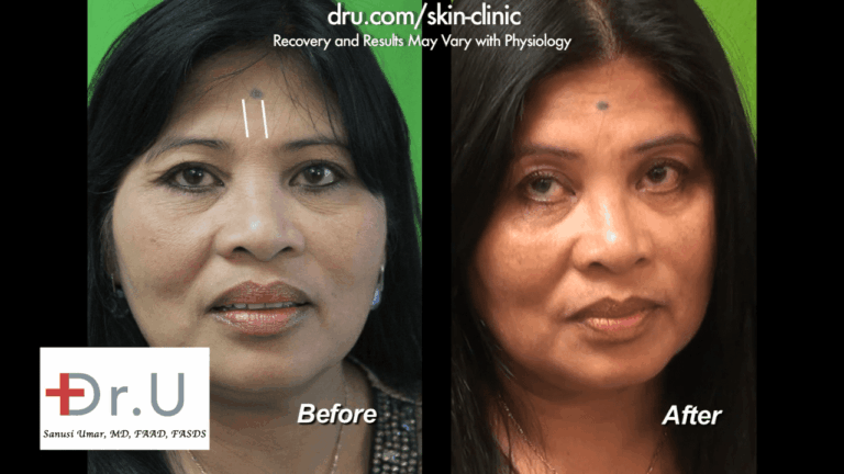 This patient decided on Belotero vs Botox and is happy with her results.*