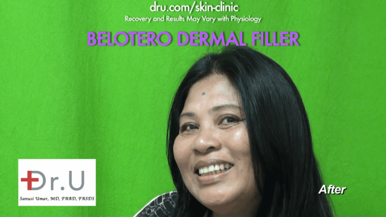 The Belotero dermal filler successfully eliminated the fine wrinkle wrinkles know as 11 between the eyes *