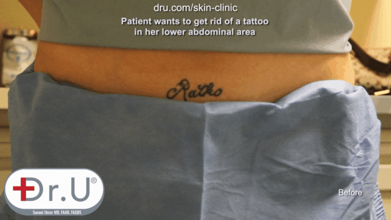 Does laser tattoo removal work? This Manhattan Beach patient wanted a tattoo removed from the abdominal area.