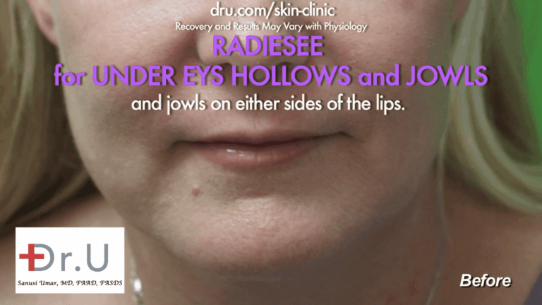 The Manhattan Beach patient wanted to know how to get rid of jowls without surgery, so she consulted Dr. U in his Los Angeles clinic.