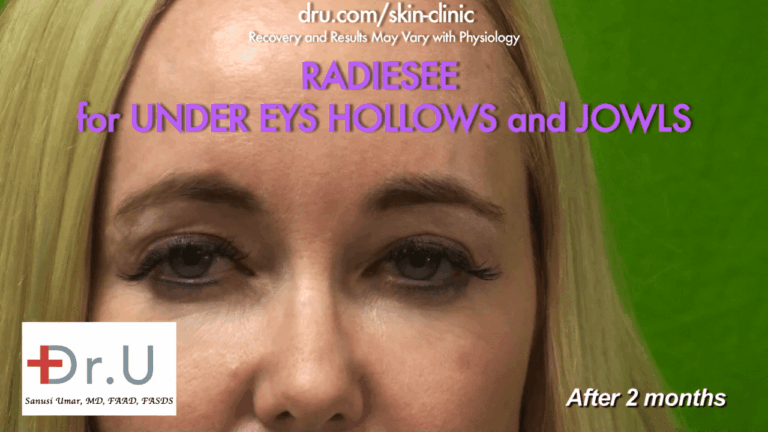 The Manhattan Beach patient's treatment with under eye hollows filler Radiesse was expertly injected by Dr. U*