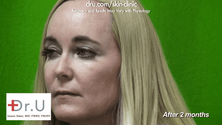 The Manhattan patient shows a side view after Dr. U used Radiesse to get rid of jowls without going under the knife.*