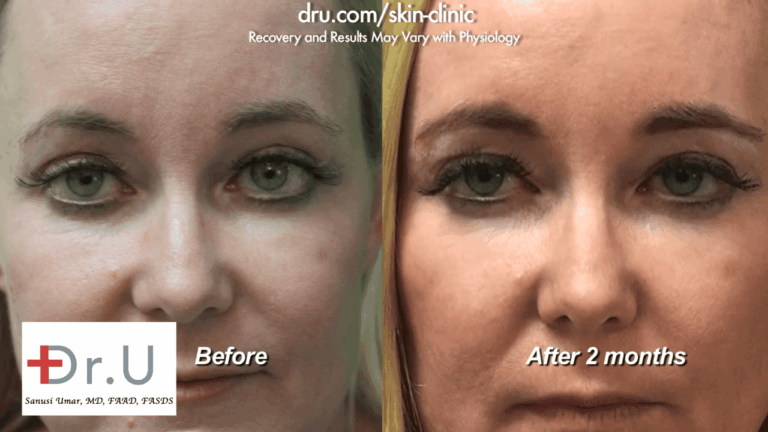 Successful treatment with dermal fillers for under eye bags before and after as seen on the Manhattan Beach patient at the Dr. U Skin Clinic
