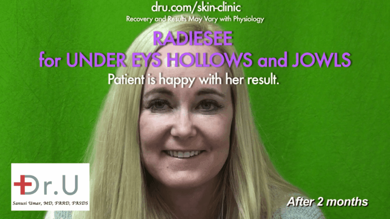 The Manhattan Beach patient was satisfied with the jowl lift with fillers and under eye hollows filler at Dr. U's Los Angeles based clinic*