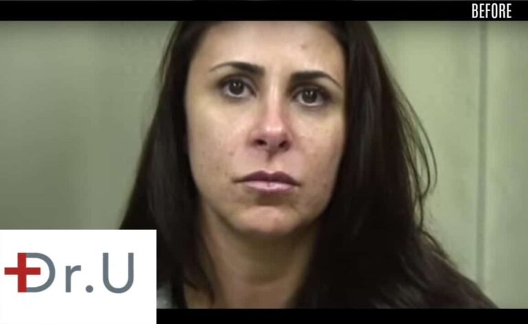Westlake Village, Los Angeles patient before her treatment with a laugh lines filler.