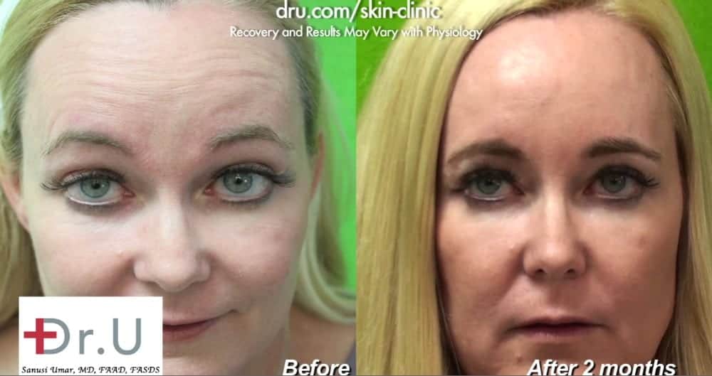 Patient is happy with her outcome using Botox for forehead wrinkles & crows feet.*
