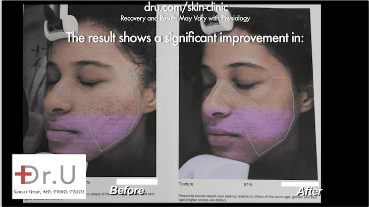 Using the Fraxel Dual can offer the best laser treatment for acne scars, particularly for ethnic patients. This is due to the ability of the laser to target areas without overheating the surrounding skin.* Using the Fraxel Dual can offer the best laser treatment for acne scars, particularly for ethnic patients. This is due to the ability of the laser to target areas without overheating the surrounding skin.*