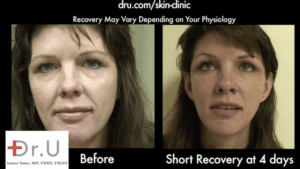 Patient's nasolabial folds show major improvement 4 days after her Silhouette Lift
