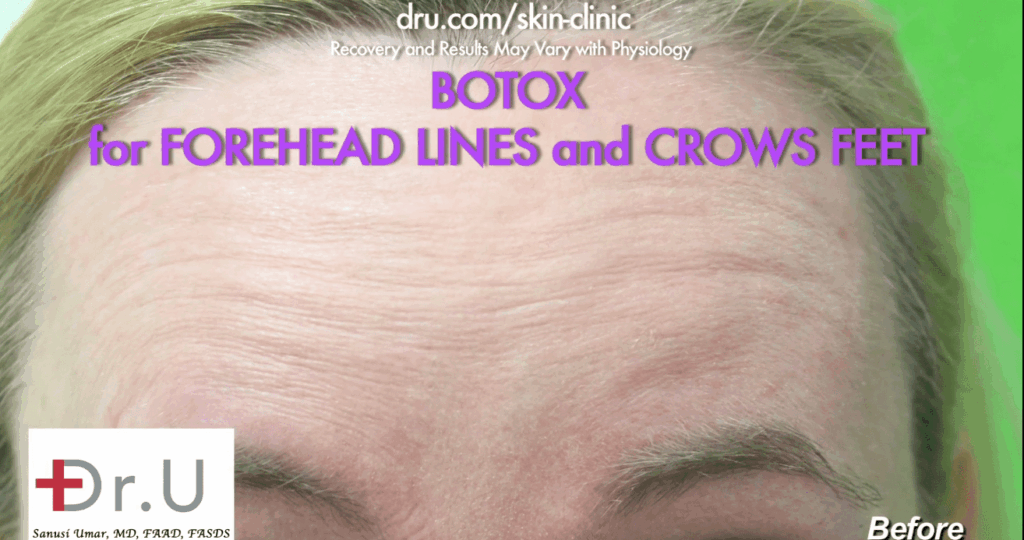 Beverly Hills patient before procedure using Botox for forehead wrinkles.