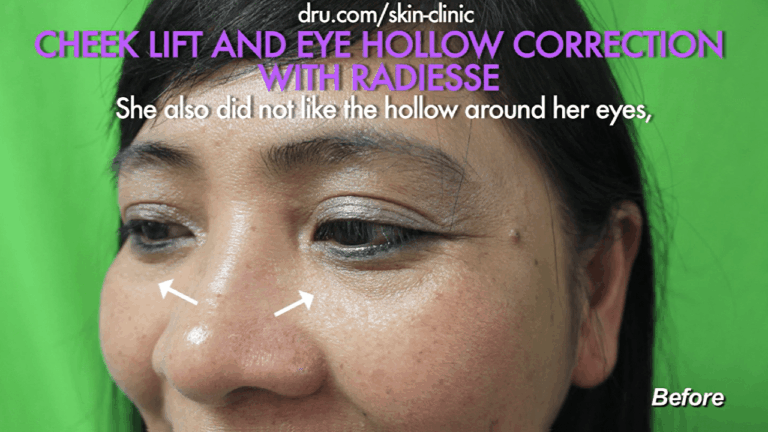 Patient from El Segundo wanted to fix sunken under eye hollows.