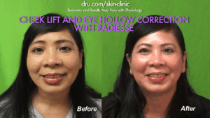 El Segundo, Los Angeles patient before and after the best non surgical cheek lift at Dr. U Skin Clinic.