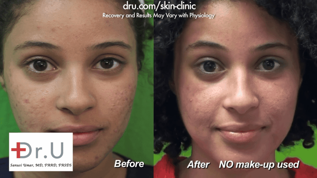 The patient is very happy with her results from Dr. U Skin Clinic after her Fraxel Dual laser treatment for acne scars.* The patient is very happy with her results from Dr. U Skin Clinic after her Fraxel Dual laser treatment for acne scars.