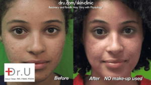 The patient is very happy with her results from Dr. U Skin Clinic after her Fraxel Dual laser treatment for acne scars.