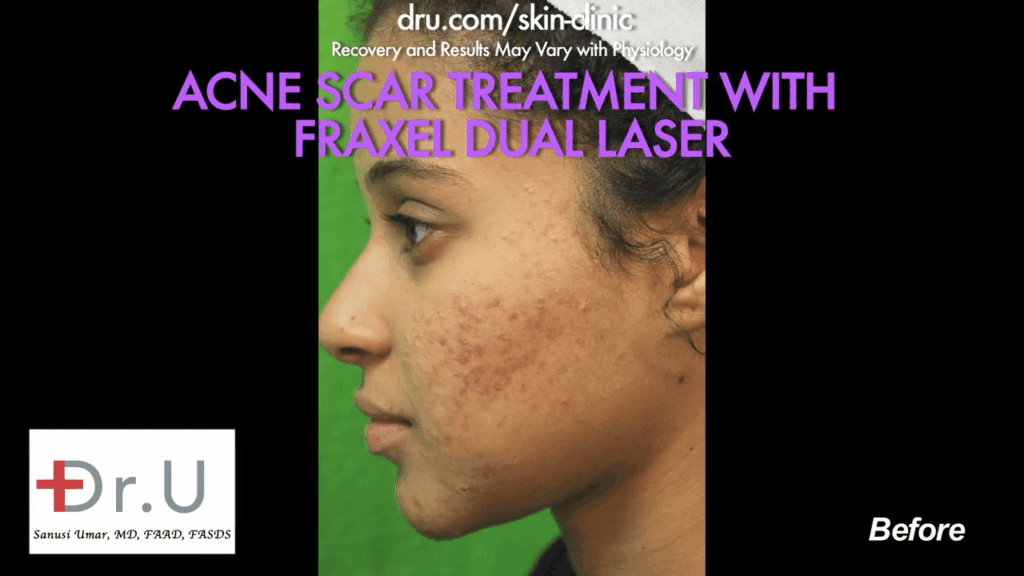 Santa Monica patient struggled with acne in college and was resigned with it. She had tried over-the-counter medication, which did not work, so she followed up with Dr. U for laser treatment for acne scars.* Santa Monica patient struggled with acne in college and was resigned with it. She had tried over-the-counter medication, which did not work, so she followed up with Dr. U for laser treatment for acne scars.*