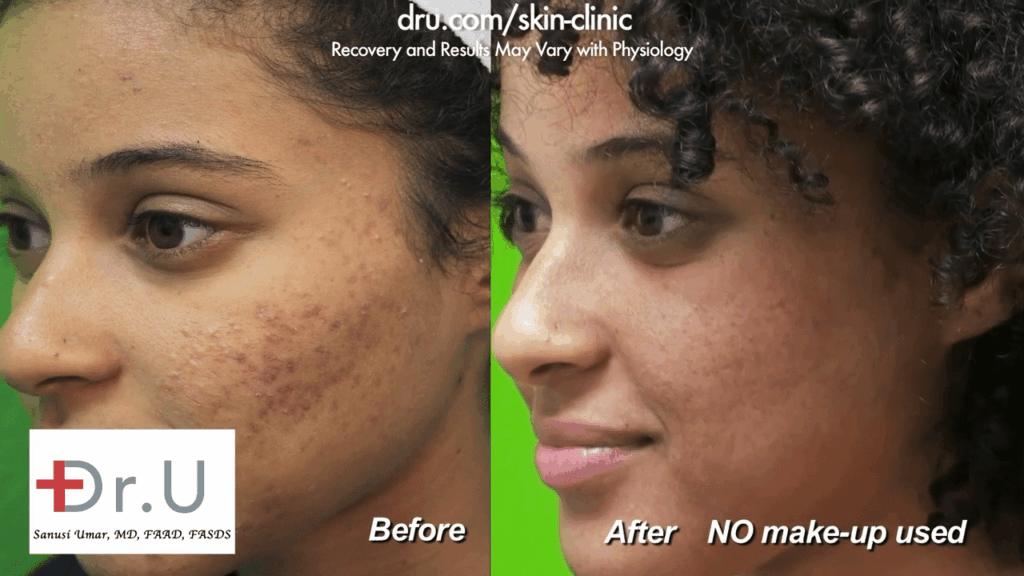 The patient from Los Angeles is able to feel comfortable in her own skin without the use of makeup to cover her acne scars. For many people who struggle with acne scarring, this feeling far outweighs laser treatment for acne scars cost.* The patient from Los Angeles is able to feel comfortable in her own skin without the use of makeup to cover her acne scars. For many people who struggle with acne scarring, this feeling far outweighs laser treatment for acne scars cost.*
