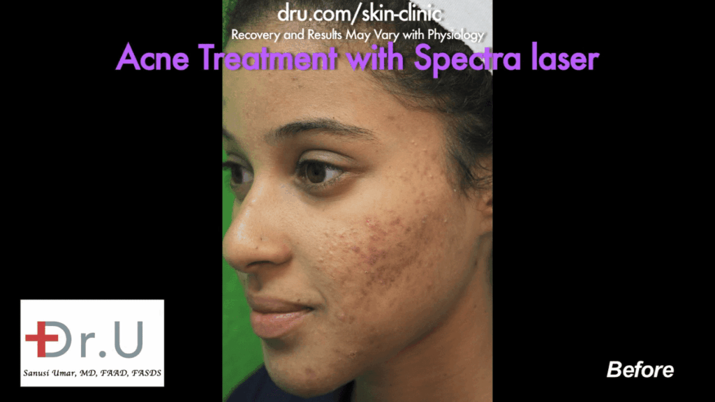 This Santa Monica patient consulted Dr. U about a laser treatment for Acne. Due to her skin type, Dr. U recommended the Spectra laser for safe and effective treatment.