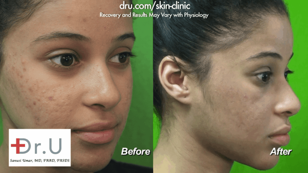 After searching high and low for an "acne laser treatment near me", this Santa Monica patient was pleased to find the Dr. U Skin Clinic. She is happy with her Spectra laser treatment results.