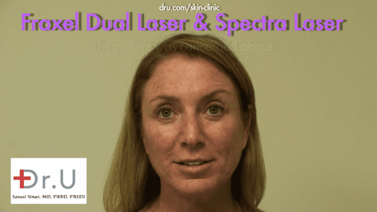 This patient from El Segundo, Los Angeles consulted Dr. U about age spots on face and neck areas. The appearance of the brown dots concerned her. This patient from El Segundo, Los Angeles consulted Dr. U about age spots on face and neck areas. The appearance of the brown dots concerned her.