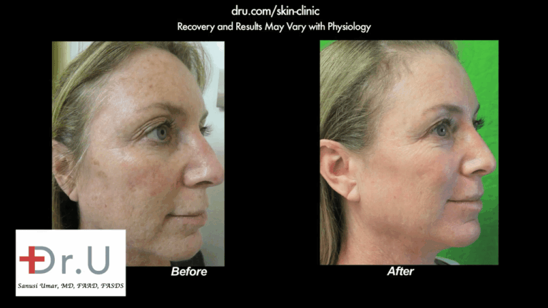 Profile view showing the other side of the patient's face after undergoing the best age spot remover treatment with Dr. U in Los Angeles.* Profile view showing the other side of the patient's face after undergoing the best age spot remover treatment with Dr. U in Los Angeles.*