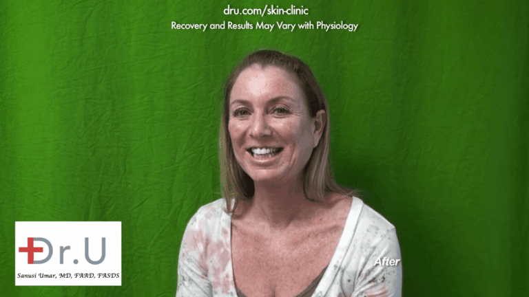 The patient was very happy and would recommend treatment with Dr. U to anyone wondering how to remove age spots on face. The patient was very happy and would recommend treatment with Dr. U to anyone wondering how to remove age spots on face.