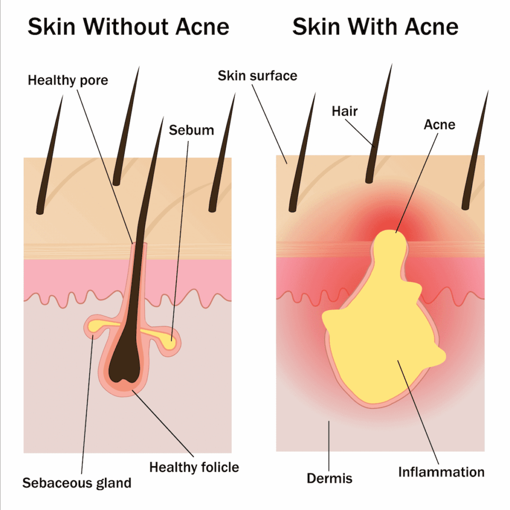 Acne is the result of an inflamed or infected sebaceous gland. Laser therapy can be an effective way to target these inflamed glands.