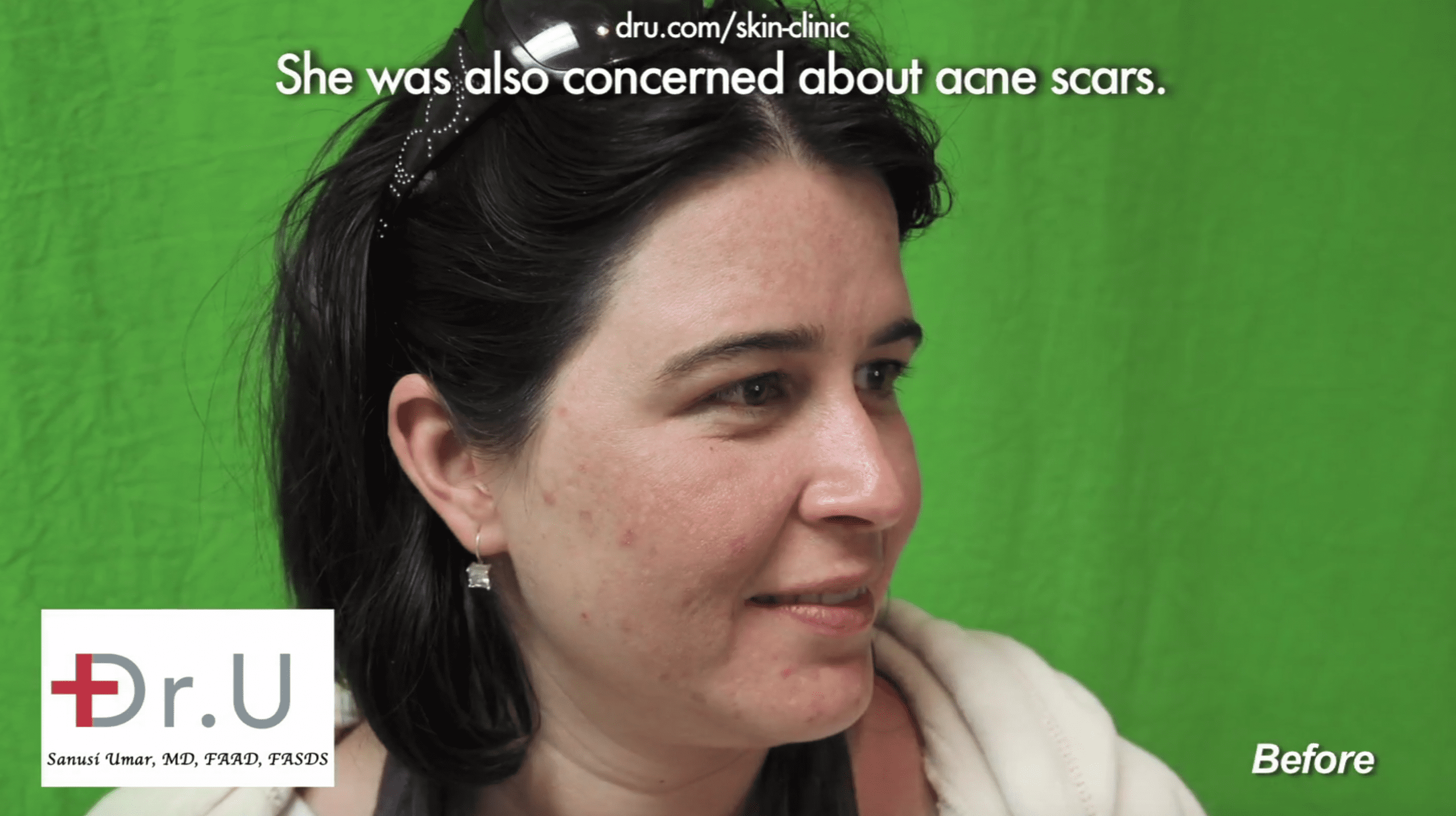 The patient’s acne-prone skin prior to adult acne treatment at Dr. U Skin Clinic