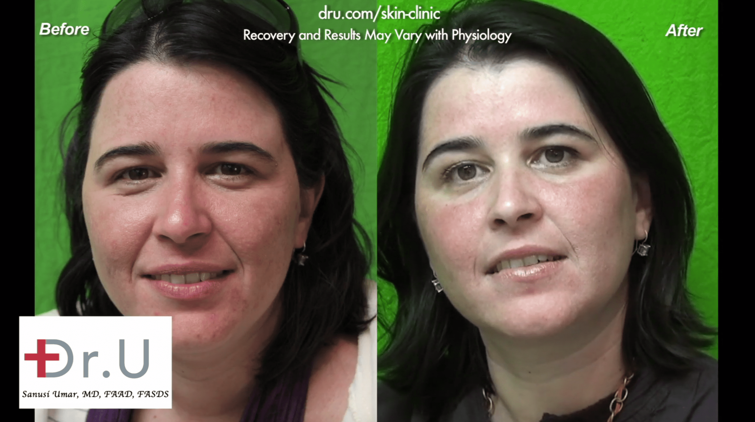 This patient found relief from adult acne at Dr. U Skin Clinic.*