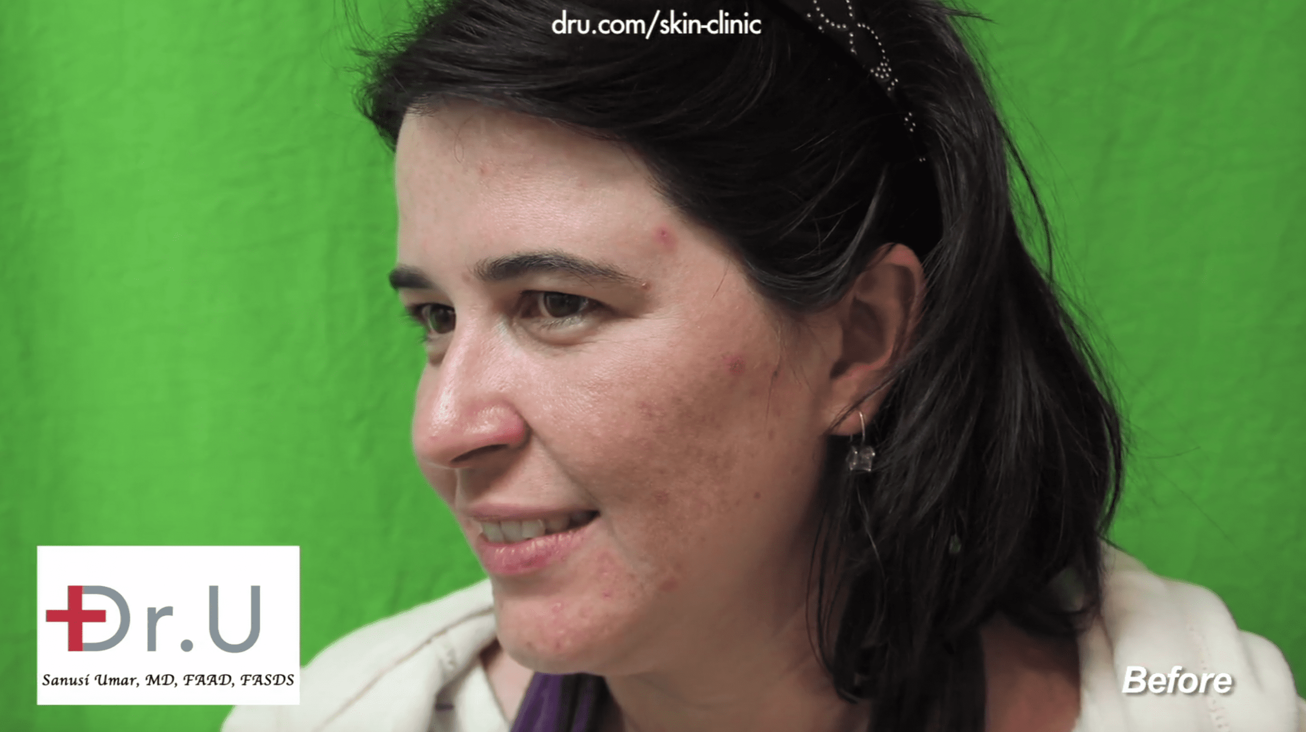 Unknown adult acne causes left this patient with broken skin before finding Dr. U Skin Clinic.