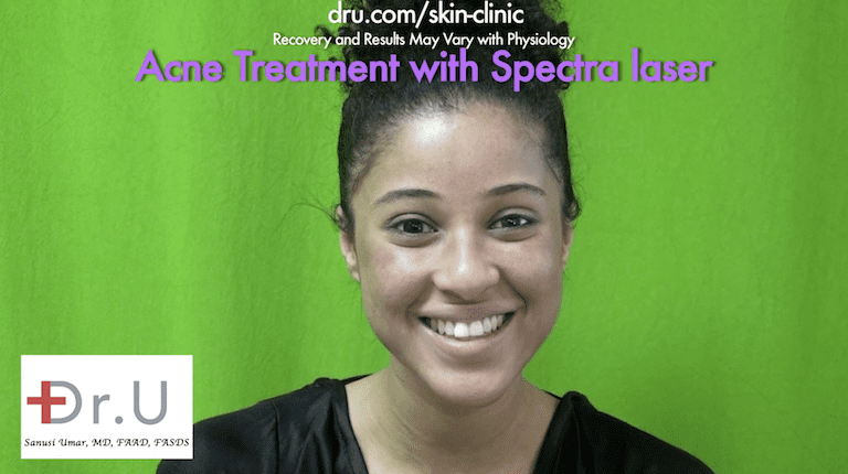 The patient is happy with her Spectra laser skin acne treatment at Dr. U Skin Clinic.