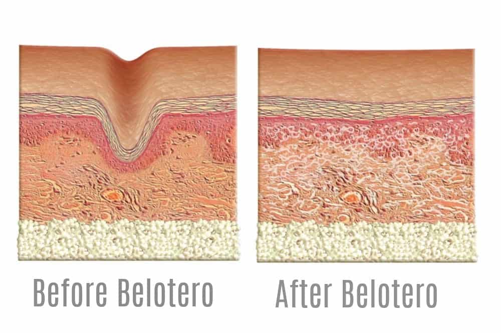 How Belotero works for forehead creases and other wrinkles. Image - Belotero.com How Belotero works for forehead creases and other wrinkles. Image - Belotero.com