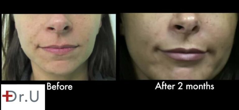 Patient is happy with her laugh line treatment results at two months.*