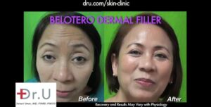 Dr. U's treatment with Belotero for forehead wrinkles helped this patient look her absolute best.