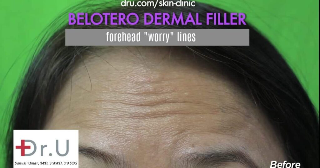 Manhattan Beach patient hopes for improvement using Belotero for forehead wrinkles. Manhattan Beach patient hopes for improvement using Belotero for forehead wrinkles