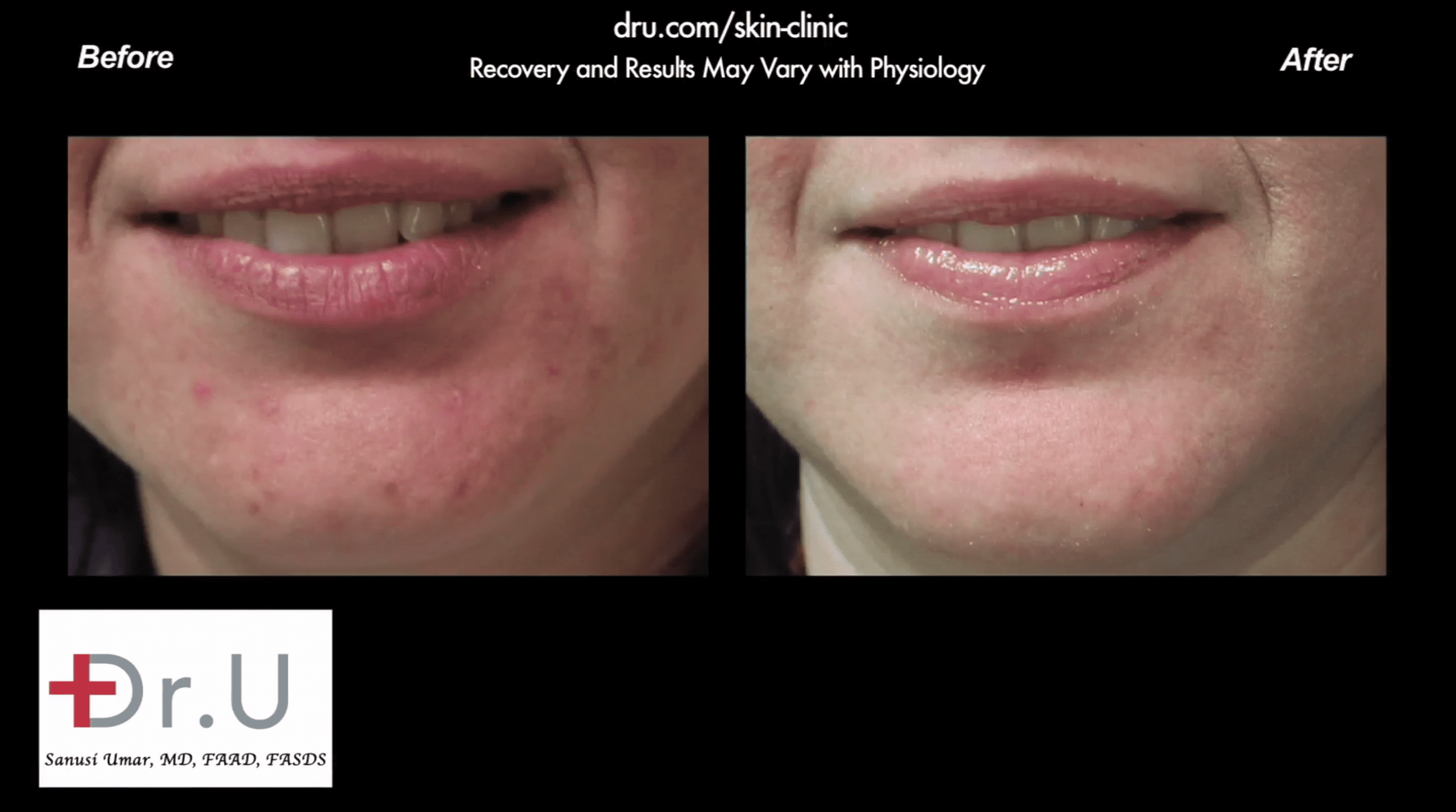 Before and after patient received one of the best acne treatment products for adults.