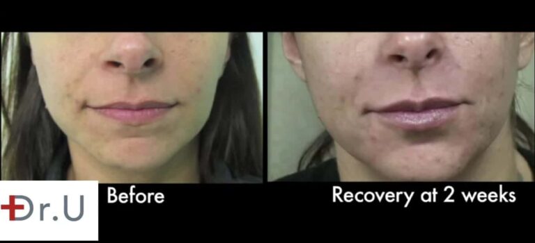 Close up view before and after Dr. U's laugh line filler treatment.*